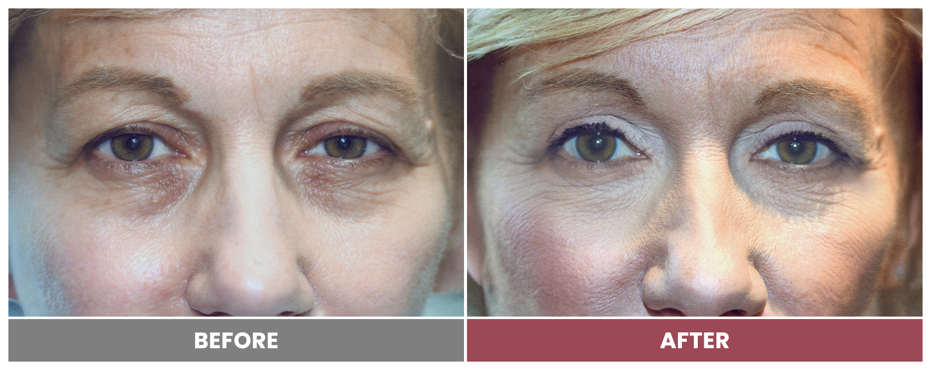 BLEPHAROPLASTY & PTOSIS REPAIR - Case 1